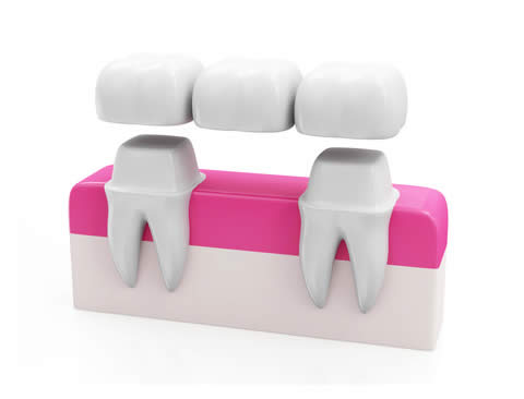 Dental bridge