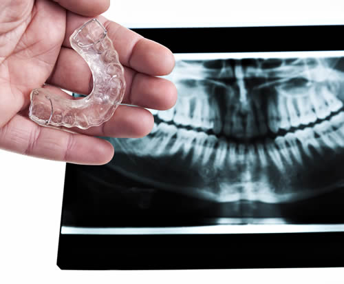 bruxism