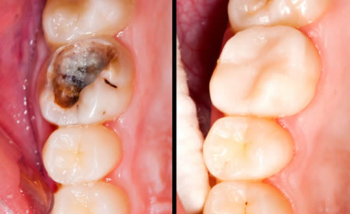 cosmetic tooth coloured fillings