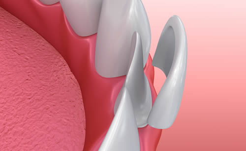 Dental veneers