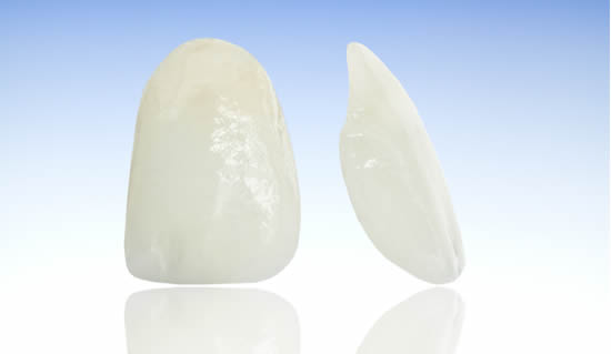 dental veneer